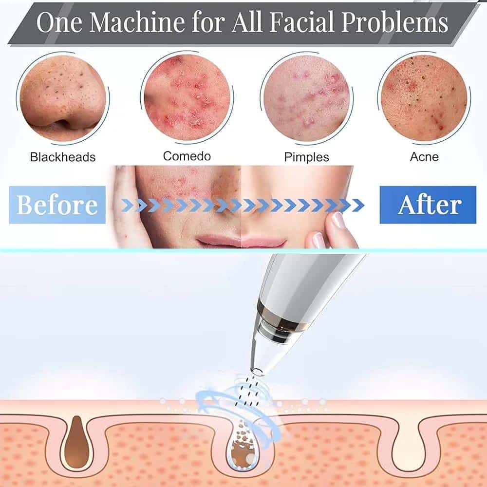 Vacuum Blackhead Remover Cleaner - Image 2